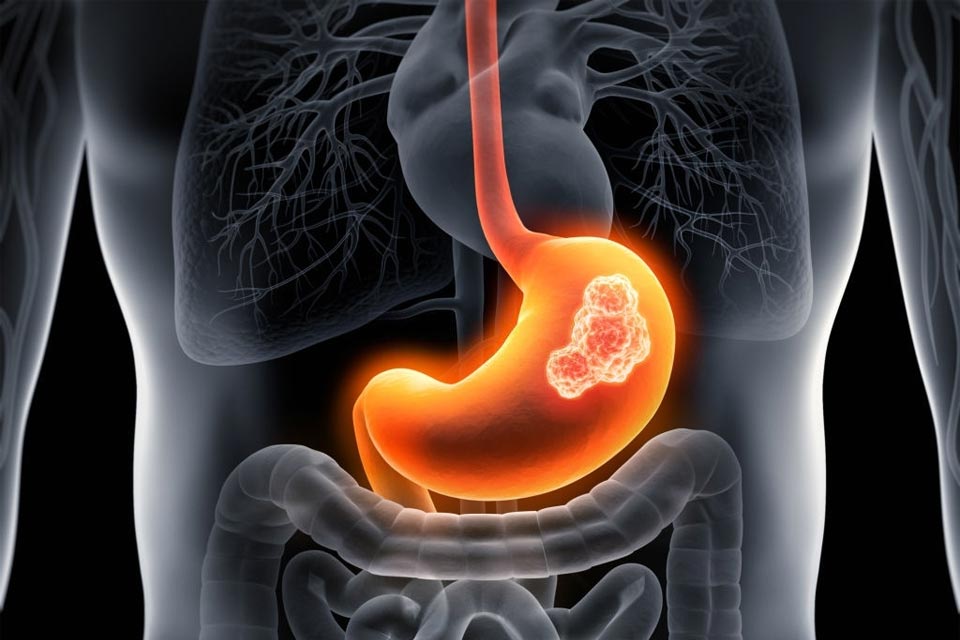 Stomach Problem